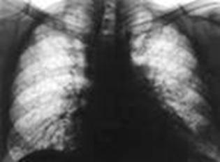 Alveolita fibroasa idiopatica, prognostic