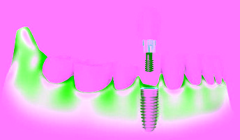 Implantarea dinților, implanturilor dentare, chisinau, moldova