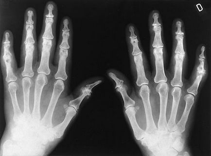 Artrita infecțioasă (artrită nespecifică), simptomele, semnele, diagnosticul și tratamentul