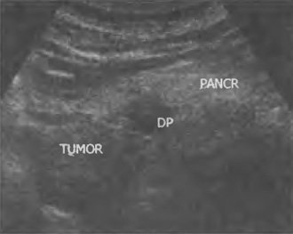 Instrumente metodice pentru diagnosticarea tumorilor pancreatice
