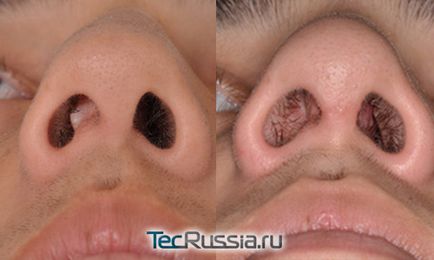 Викривлення носової перегородки - фото, способи лікування, операція, ціни