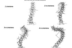 Care sunt consecințele scoliozelor coloanei vertebrale?