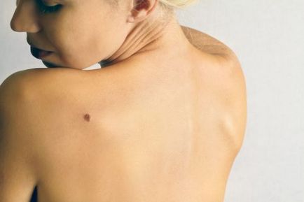 Cum să distingem un semn de naștere de un melanom cum să înțelegem că există o degenerare