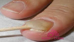 Кандидоз нігтів причини і лікування