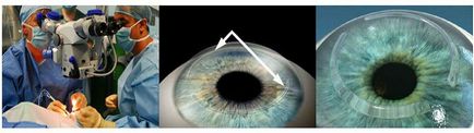 Keratoconus al corneei ochiului - cauze, simptome și tratamentul bolii, prețurile tranzacțiilor