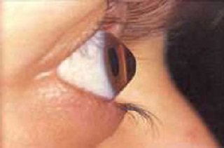 Кератоконус рогівки ока - причини, симптоми і лікування захворювання, ціни на операцію