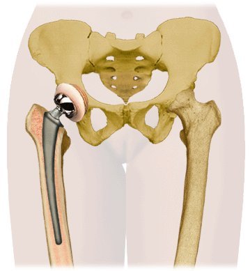 Coxartroza moderna a metodelor de tratament - primul medical