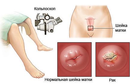 Кольпоскопія шийки матки - обов'язкова процедура для кожної жінки