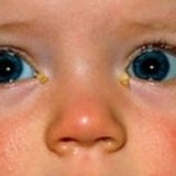 Шкірні хвороби новонароджених - скальпель - медичний інформаційно-освітній портал