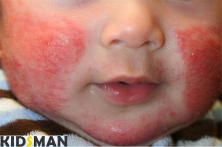 Vörös arca csecsemők okok és a kezelés