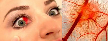 Eye vérzés (vérzés a szem) Vérzés a szemben