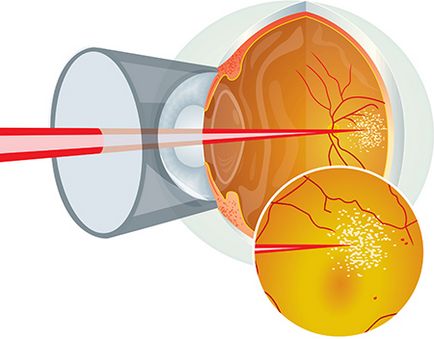 Coagularea cu retină laser
