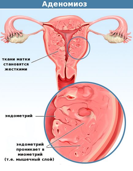 Tratament fără hormoni, bufeuri cu menopauză, endometrioză, ovar polichistic