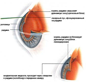 Tratamentul medicamentelor pentru glaucom, picături de cefalee sau intervenții chirurgicale