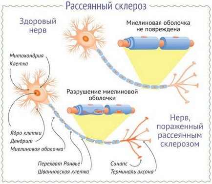 Лікування розсіяного склерозу, медична література, книги з медицини, підручники, медичні