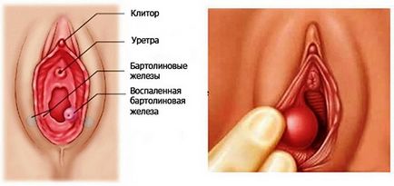 Tratamentul trichomoniei cu remedii folclorice la domiciliu, iarbă, metronidazol