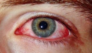 Explozia vasului în tratamentul ochiului pentru diferite tipuri de hemoragie