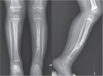 Pseudarthrosis törés után