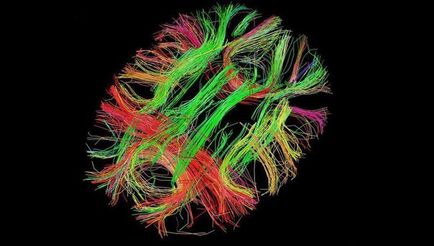 LSD și efectul său asupra creierului uman