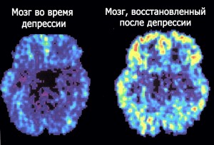 Маніакальна депресія причини, симптоми, фази захворювання та лікування