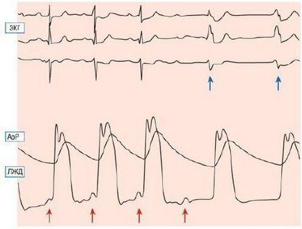 Metode de tratament a cardiomiopatiei hipertrofice