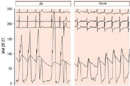 Metode de tratament a cardiomiopatiei hipertrofice