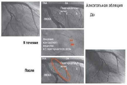 Metode de tratament a cardiomiopatiei hipertrofice