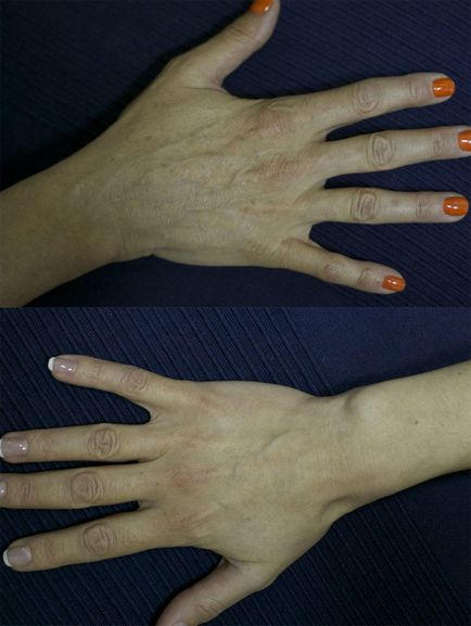 Методи омолодження шкіри рук