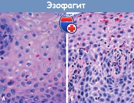 Mecanismul de dezvoltare (patogeneză) de esofagită de reflux (gerb)