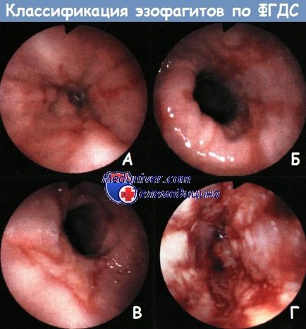 Mecanismul de dezvoltare (patogeneză) de esofagită de reflux (gerb)