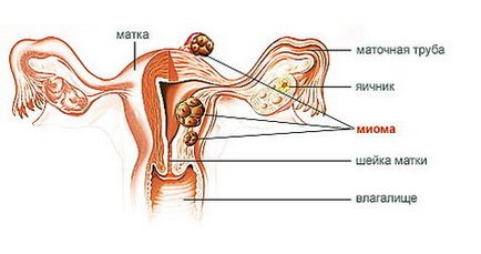 Myoma uterului pentru a trata sau a astepta