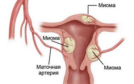 Myomul uterului cu simptome și tratament pentru menopauză