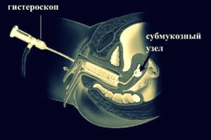 Méhfibróma jelek és tünetek a menopauza idején, a kezelés