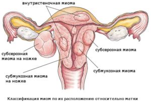 Méhfibróma jelek és tünetek a menopauza idején, a kezelés