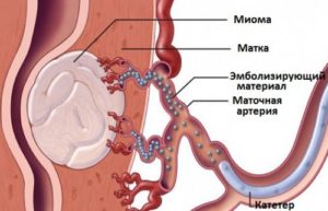 Méhfibróma jelek és tünetek a menopauza idején, a kezelés