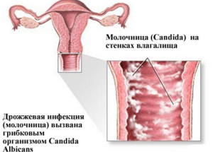 Tratamentul cu pastile cu remedii folclorice la domiciliu