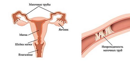 Obstrucția tuburilor uterine - merită să-și piardă speranța, fiica în creștere, fiul în creștere