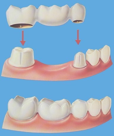 Незнімні зубні протези різновиди пристосування і які вибрати