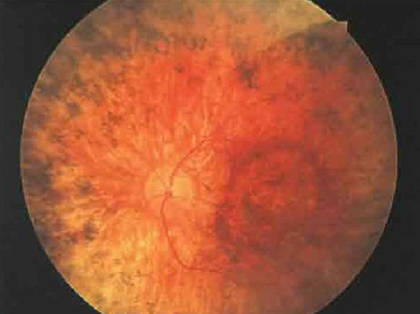 Нічна сліпота симптоми, діагностика, профілактика