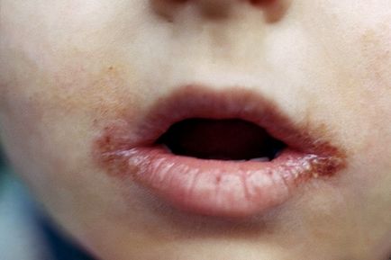 Buzele provoacă un motiv - tratamentul buzelor, care sunt fulgi, mâncărime și blush, polina și lumea