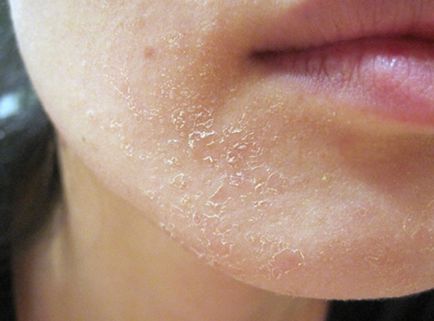 Облазив губи причина - лікування губ, які лущаться, сверблять і червоніють, поля і світ