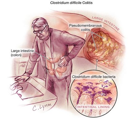 Exacerbarea colitei intestinului, ce trebuie făcut în cazul unui atac acut