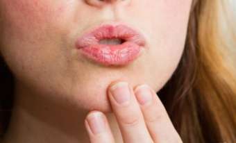 Buzele batete de vreme - tratamentul la domiciliu, decât să frământa 