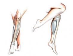 Nagyon vékony lábak, hogy a sebészek ezt pótolni az összeget a lábszáron