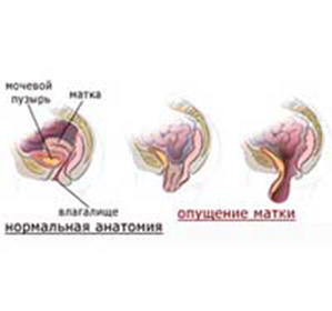 Опущення шийки матки лікування і симптоми - ваша медична енциклопедія
