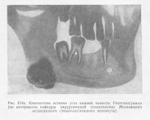 Пухлини з кісткової тканини, стоматологія