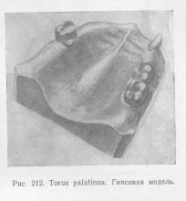 Tumori ale țesutului osos, stomatologie