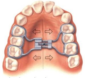 Ортодонтический апарат деріхсвайлера принцип роботи, установка, ціна, відгуки пацієнтів