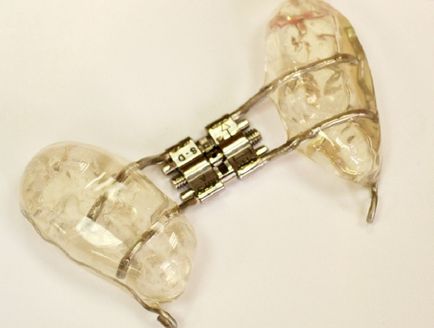 Aparatul ortodontic al principiului Derichsweiler de funcționare, instalare, preț, recenzii de pacient