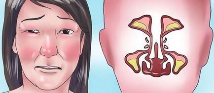 Edemul sinusului maxilar cum se elimină umflarea feței cu geniematomă
